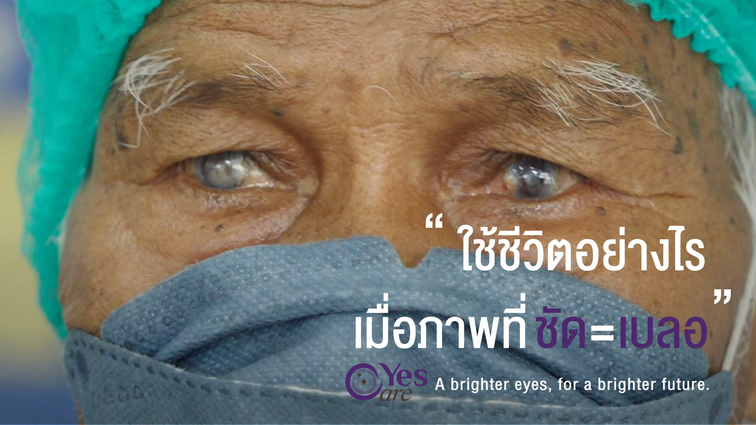  YesCare สนับสนุนโครงการผ่าตัดต้อกระจกใส่เลนส์แก้วตาเทียมแก่ผู้ยากไร้ในไทย กว่า 140 ราย